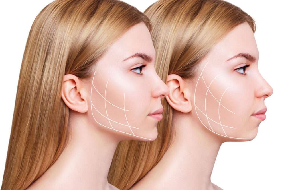 What is HIFU Face Lifting treatment and its benefits?